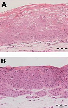 The W12 cell line system is an accurate model of progression from low-grade pre-cancer (A) to squamous cell carcinoma (B).