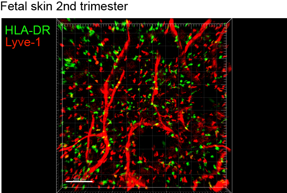 Immune cells are stained with anti-human HLA-DR (green), lymphatic vessels are stained with lyve-1 (green).