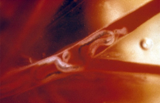 A macroscopic view of the portal vein of an experimental mouse host. The blood vessel contains a coiled Schistosoma mansoni worm pair. Credit: Wellcome Library, London.